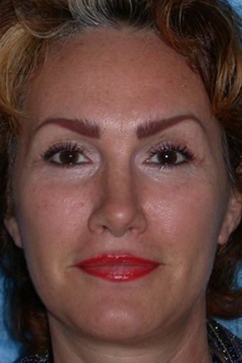 Rhinoplasty after 81112
