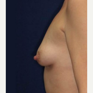 25-34 year old woman treated with Breast Lift with Implants before 3520157
