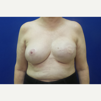Breast Reconstruction Revision after 3644765