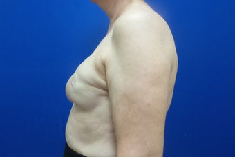 Breast Reconstruction Revision 3644765
