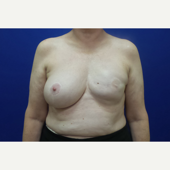 Breast Reconstruction Revision before 3644765
