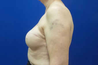 Breast Reconstruction Revision 3644765