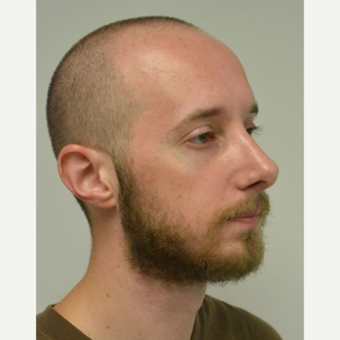 25-34 year old man treated with Nose Surgery after 3099121