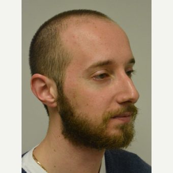 25-34 year old man treated with Nose Surgery before 3099121