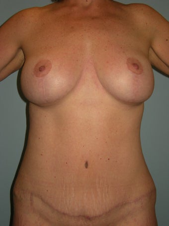 Mommy Makeover after 1356979
