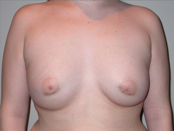 21 year old with severe tuberous breast deformity after 904677