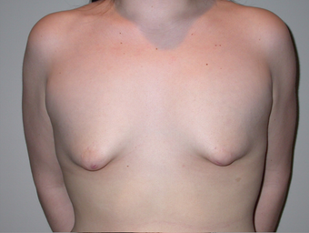 21 year old with severe tuberous breast deformity before 904677