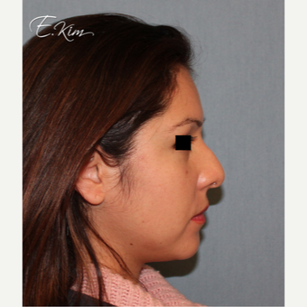 35-44 year old woman treated with Rhinoplasty before 3577991