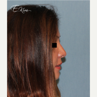 35-44 year old woman treated with Rhinoplasty after 3577991