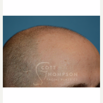 35-44 year old man treated with Hair Transplant before 3724378