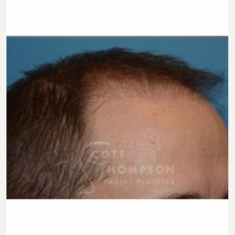 35-44 year old man treated with Hair Transplant after 3724378