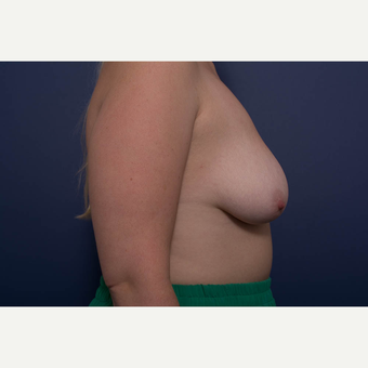 25-34 year old woman treated with Breast Lift with Implants before 3728893