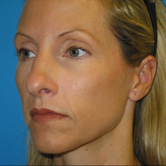 40 year Old Woman seeking additional facial volume with Sculptra after 1007721