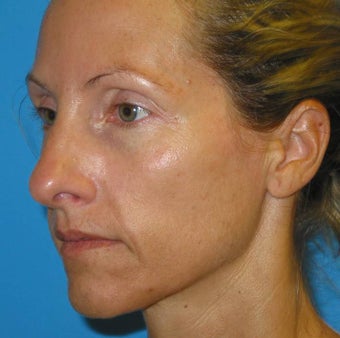 40 year Old Woman seeking additional facial volume with Sculptra before 1007721
