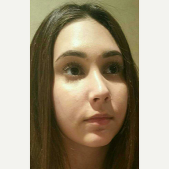 18-24 year old woman treated with Rhinoplasty after 3687061