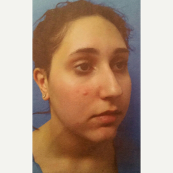 18-24 year old woman treated with Rhinoplasty before 3687061