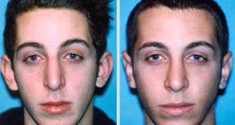 Young Male Receives Rhinoplasty to Correct Curved Bridge with Natural Results before 1344018
