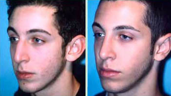 Young Male Receives Rhinoplasty to Correct Curved Bridge with Natural Results after 1344018