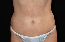 Mini Tummy Tuck after 1158733