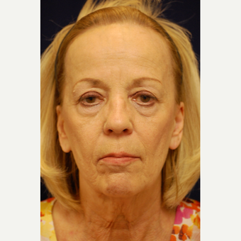 65-74 year old woman treated with Facelift before 3321664