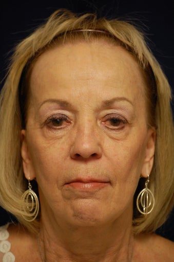 65-74 year old woman treated with Facelift after 3321664