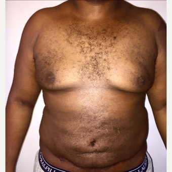 25-34 year old man treated with Male Breast Reduction after 3173909