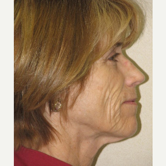 55-64 year old woman treated with Smart Lipo before 3143447