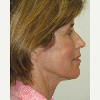 55-64 year old woman treated with Smart Lipo after 3143447