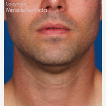 Kybella Double Chin Treatment before 2972773
