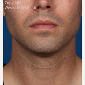 Kybella Double Chin Treatment after 2972773