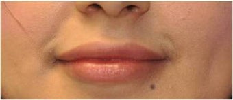 Permanent lip augmentation with Permalip implant in a young women after 1081522