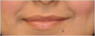 Permanent lip augmentation with Permalip implant in a young women before 1081522