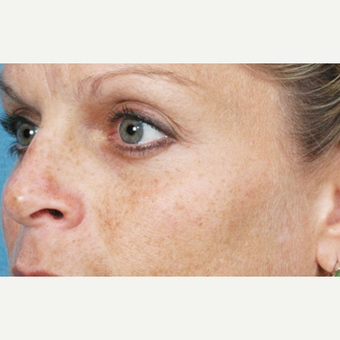 35-44 year old man treated with Skin Rejuvenation before 3141954