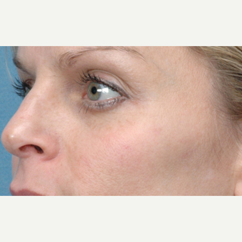 35-44 year old man treated with Skin Rejuvenation after 3141954