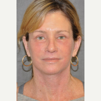 55-64 year old woman treated with Facelift after 3180733