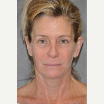 55-64 year old woman treated with Facelift before 3180733