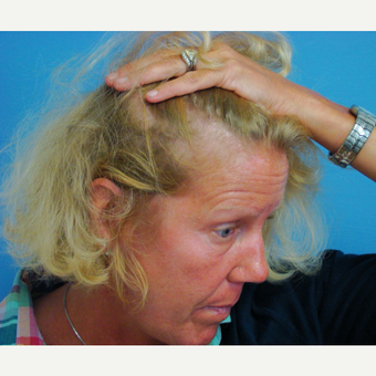 45-54 year old woman treated with Hair Transplant before 2929939