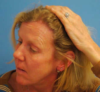 45-54 year old woman treated with Hair Transplant 2929939