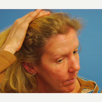 45-54 year old woman treated with Hair Transplant after 2929939