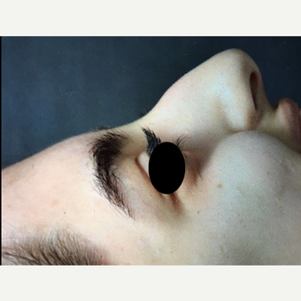 25-34 year old woman treated with Rhinoplasty before 3211857
