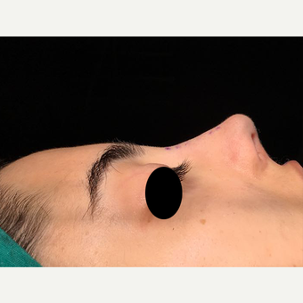 25-34 year old woman treated with Rhinoplasty after 3211857