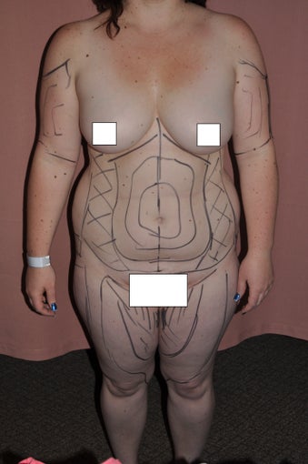 26 year old fit female patient wIth multiple areas treated by one liposuction procedure. before 769638