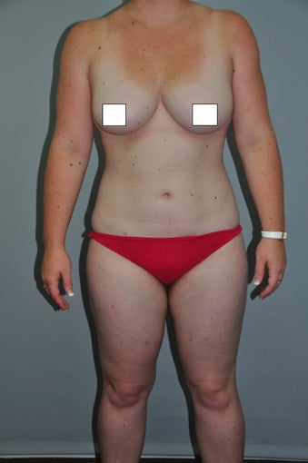 26 year old fit female patient wIth multiple areas treated by one liposuction procedure. after 769638