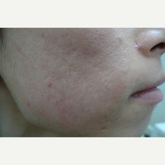 Skin treated with CO2 Fractional laser after 1764360