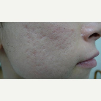 Skin treated with CO2 Fractional laser before 1764360