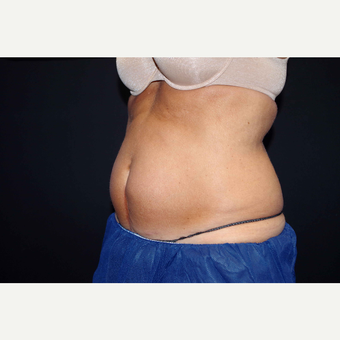 55-64 year old woman treated with CoolSculpting before 2966251