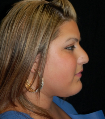 Cheek Fat Pad Removal before 1252282