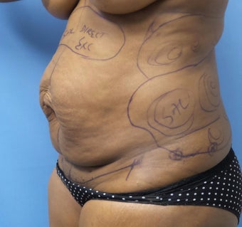 35-44 year old woman treated with Tummy Tuck before 3168365