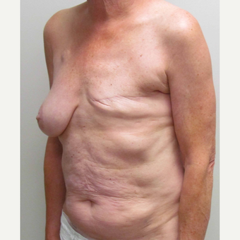 Staged Breast Reconstruction with Left DIEP flap for this 64 Year Old Woman before 3006050