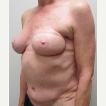 Staged Breast Reconstruction with Left DIEP flap for this 64 Year Old Woman after 3006050